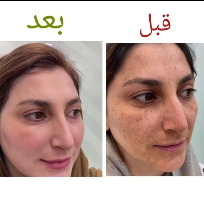 جشنواره درمان تضمینی لک و کک و مک / فقط در 1 جلسه|خدمات آرایشگری و زیبایی|اصفهان, ناژوان|دیوار