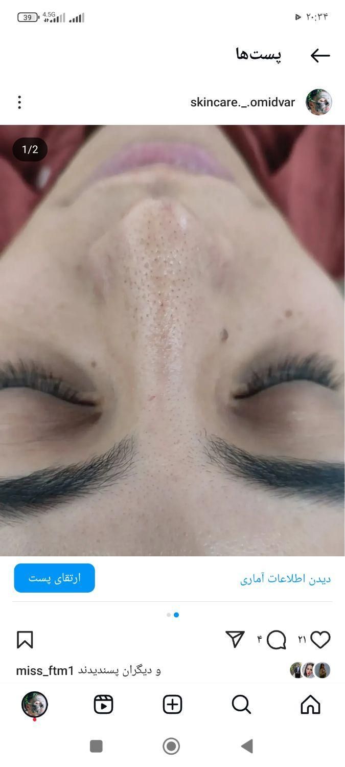 فیشال تخصصی پاکسازی۲۰۰تومان مزو کربوکسی اسیدتراپی|خدمات آرایشگری و زیبایی|مشهد, هدایت|دیوار