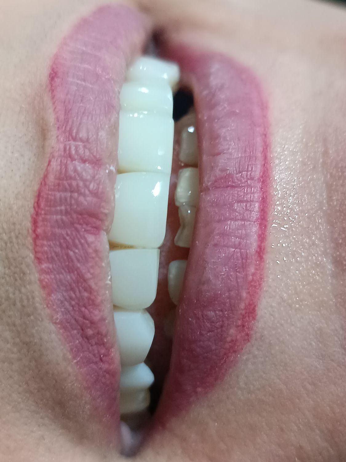 کامپوزیت دندان|خدمات آرایشگری و زیبایی|نورآباد, |دیوار