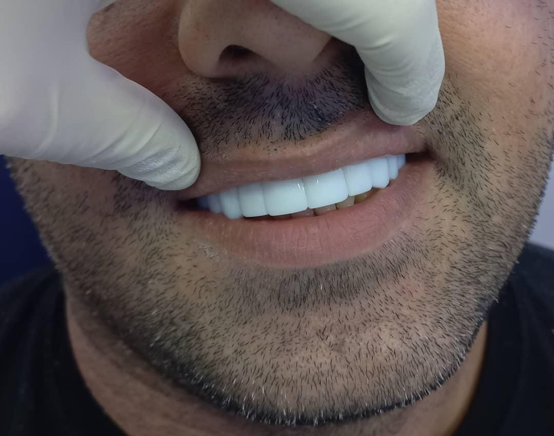 کامپوزیت دندان یاسوج|خدمات آرایشگری و زیبایی|یاسوج, |دیوار