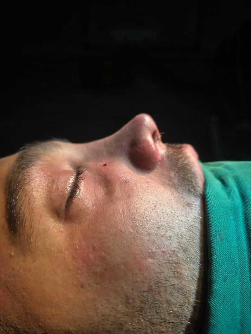 جراحی بینی ۲۴میلیون|خدمات آرایشگری و زیبایی|اسلامشهر, شهرک قائمیه|دیوار