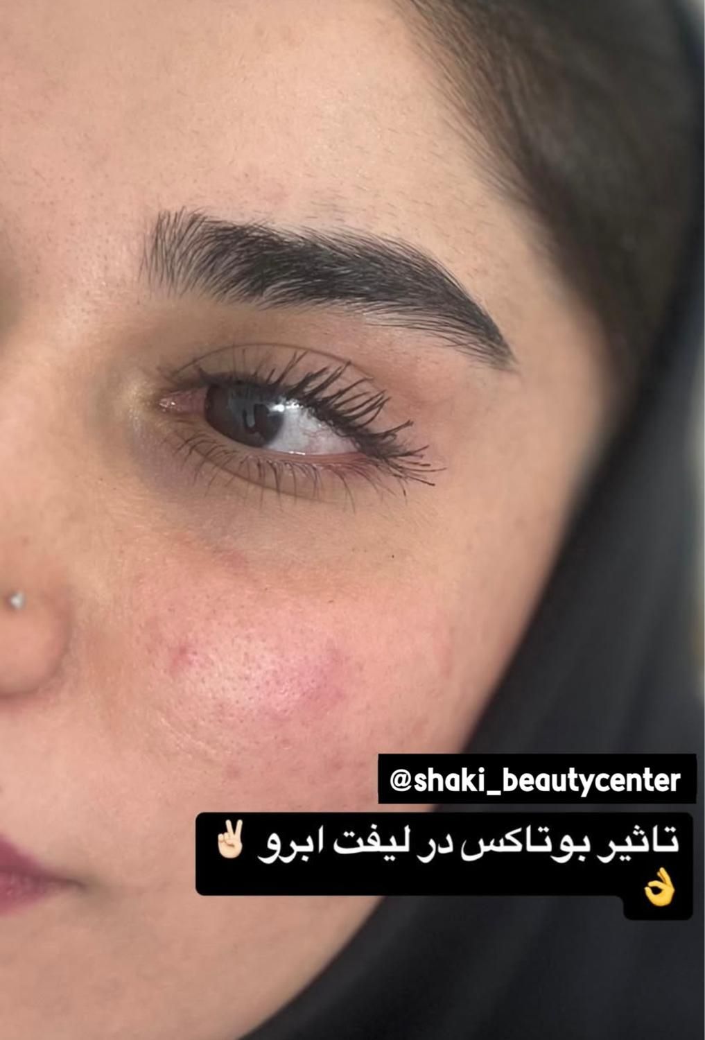 مدل بوتاکس و پی ار پی و کانتورینگ صورت با فیلر|خدمات آرایشگری و زیبایی|اصفهان, ملک‌شهر|دیوار
