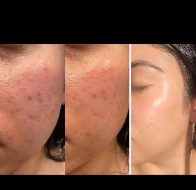 لک صورت بوتاکس خال موی سر ریش|خدمات آرایشگری و زیبایی|اهواز, کیان اباد|دیوار