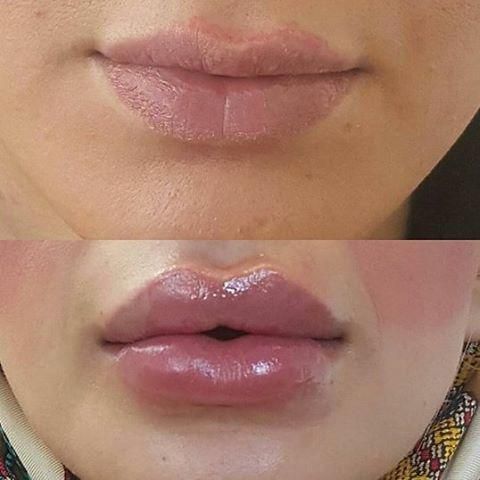 جشنواره تخفیفات ویژه ژل وبوتاکس|خدمات آرایشگری و زیبایی|گنبد کاووس, |دیوار
