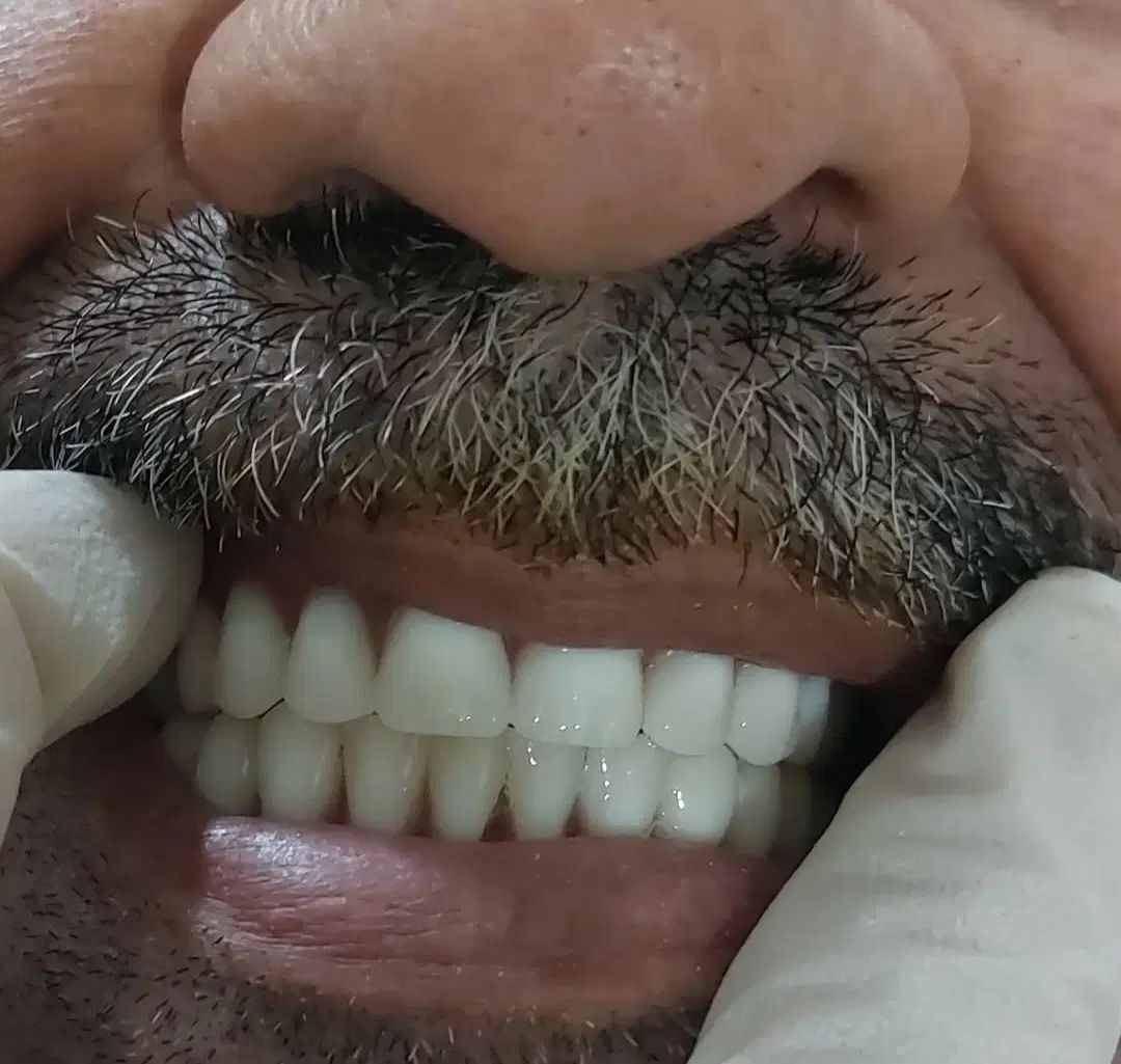 دندان مصنوعی|خدمات آرایشگری و زیبایی|کرج, کوی زنبق|دیوار