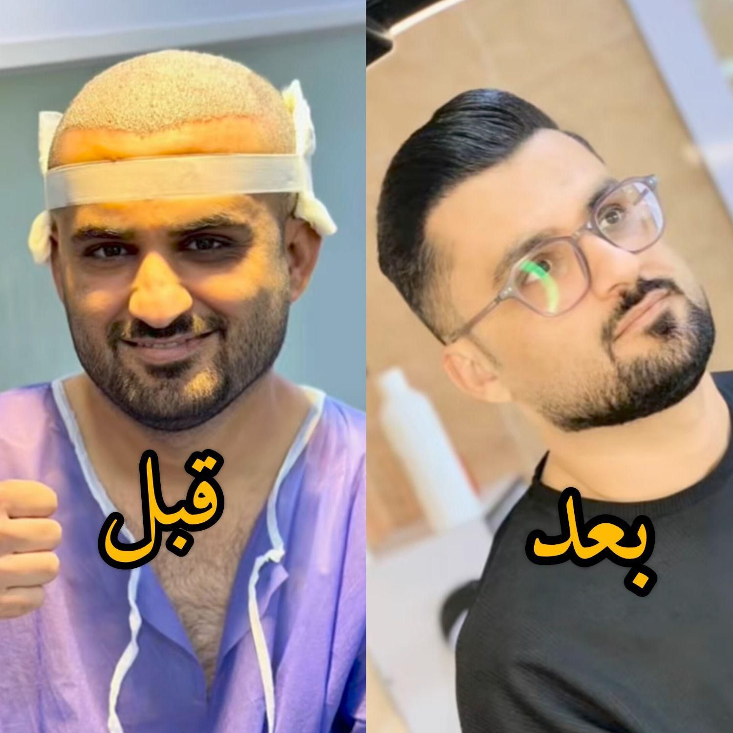 کاشت مو اقساطی باضمانت نامه کتبی مادامالعمر|خدمات آرایشگری و زیبایی|یزد, |دیوار