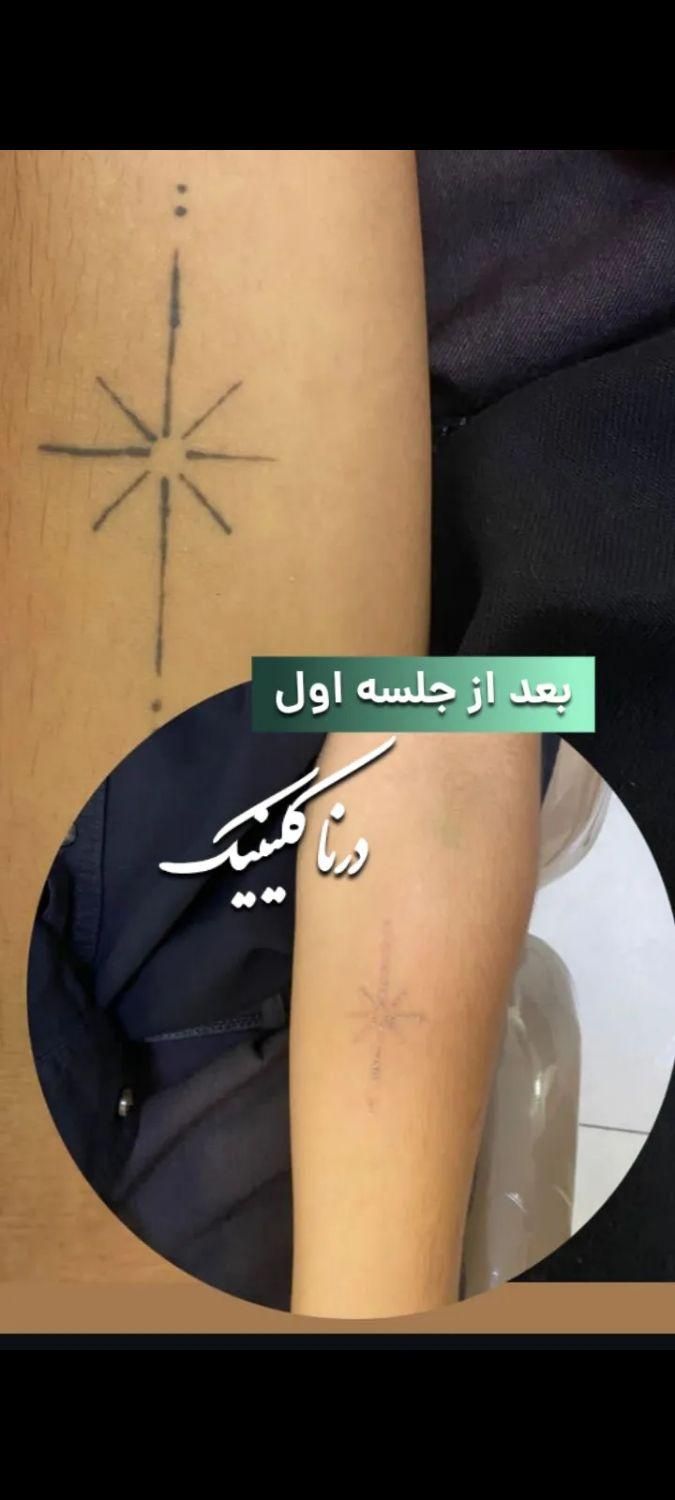 پاک کردن خالکوبی، تتو بدن و ابرو با لیزر کیوسوئیچ|خدمات آرایشگری و زیبایی|ارومیه, |دیوار