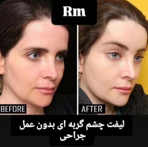 تزریق بوتاکس و لیفت چشم گربه ای  جدیدترین متد|خدمات آرایشگری و زیبایی|ری, دیلمان|دیوار