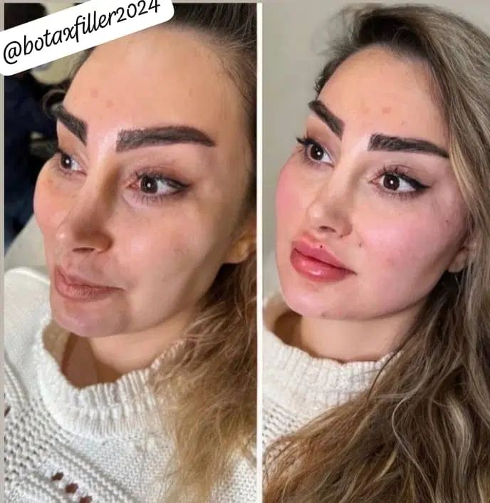 آموزش و خدمات تخصصی فیلر وبوتاکس|خدمات آموزشی|شیراز, معالیآباد|دیوار