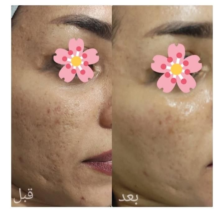 خدمات پاکسازی و جوانسازی پوست|خدمات آرایشگری و زیبایی|لاهیجان, مهرگان|دیوار