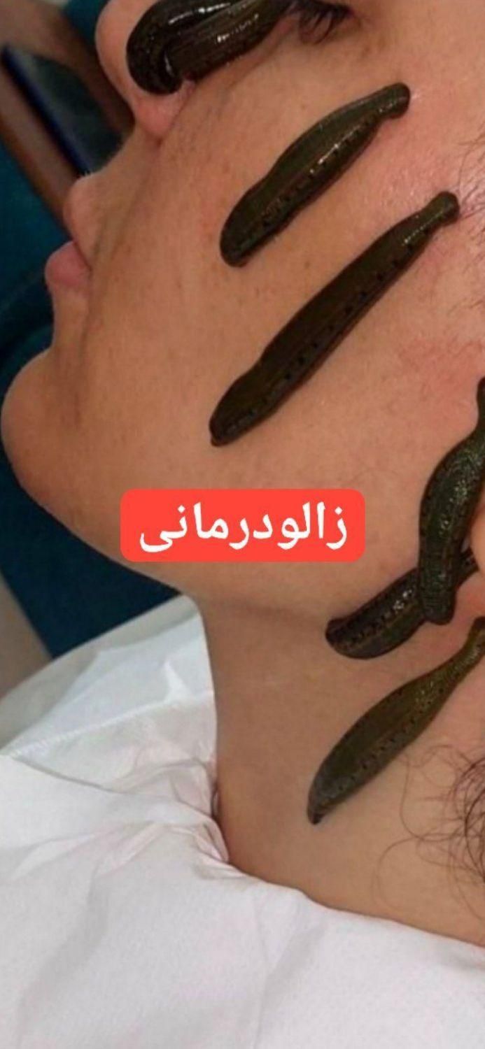 حجامت زالو سم زدایی شستشو گوش لاغری|خدمات آرایشگری و زیبایی|مشهد, شهید آوینی|دیوار