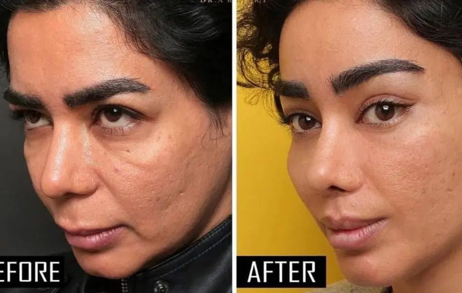 تزریق بوتاکس و لیفت چشم گربه ای  جدیدترین متد|خدمات آرایشگری و زیبایی|ری, دیلمان|دیوار