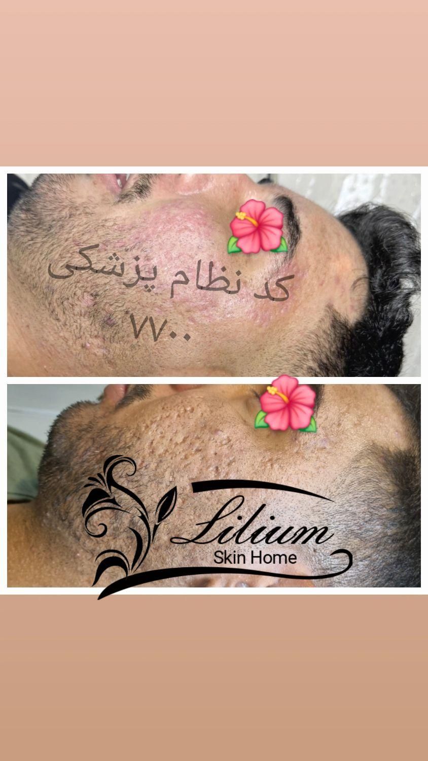 رفع جای جوش تضمینی|خدمات آرایشگری و زیبایی|اصفهان, وحید|دیوار