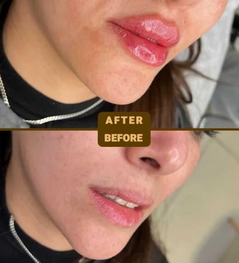 ژل لب بوتاکس زیر بغل فیلر بادی لیفت شقیقه نخ لیفت|خدمات آرایشگری و زیبایی|اصفهان, فیض|دیوار