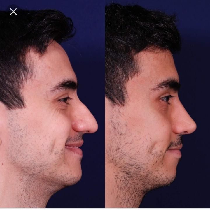 عمل جراحی بینی لیفت خدمات زیبایی با متد پیشرفته|خدمات آرایشگری و زیبایی|کرج, گلشهر|دیوار