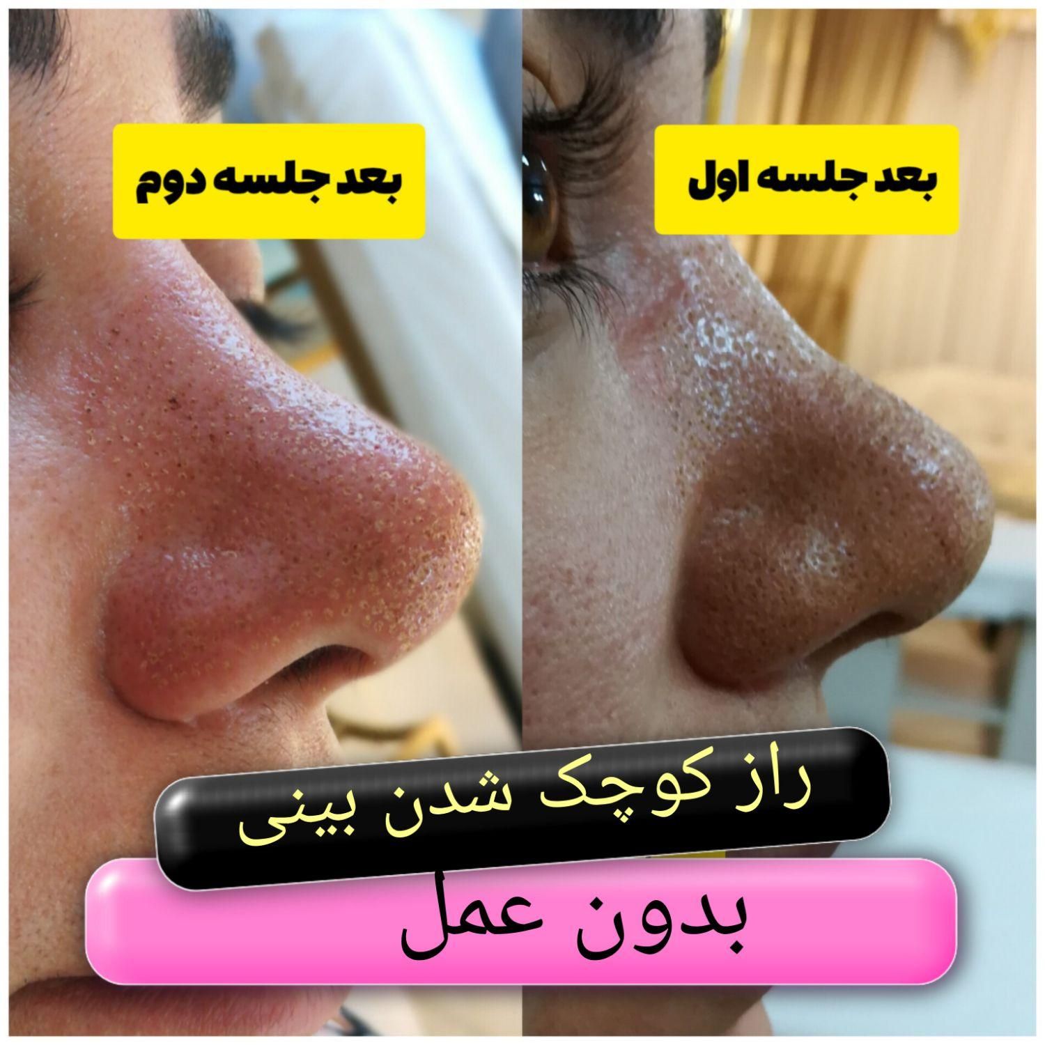 جوان سازی و لیفت به روش پلکسر بدون عمل جراحی|خدمات آرایشگری و زیبایی|مشهد, طلاب|دیوار