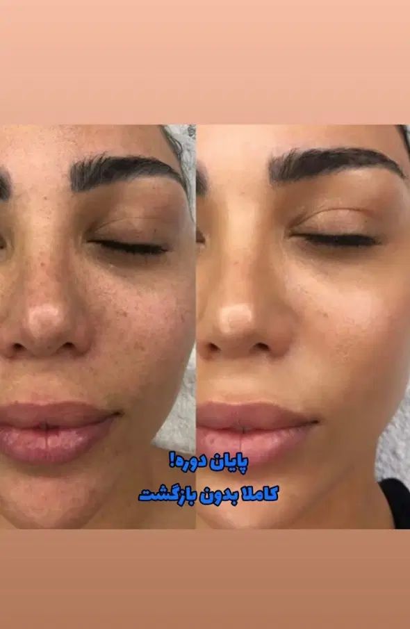 زیبایی پوستت رو به ما بسپر|آرایشی، بهداشتی، درمانی|تهران, سلسبیل شمالی|دیوار