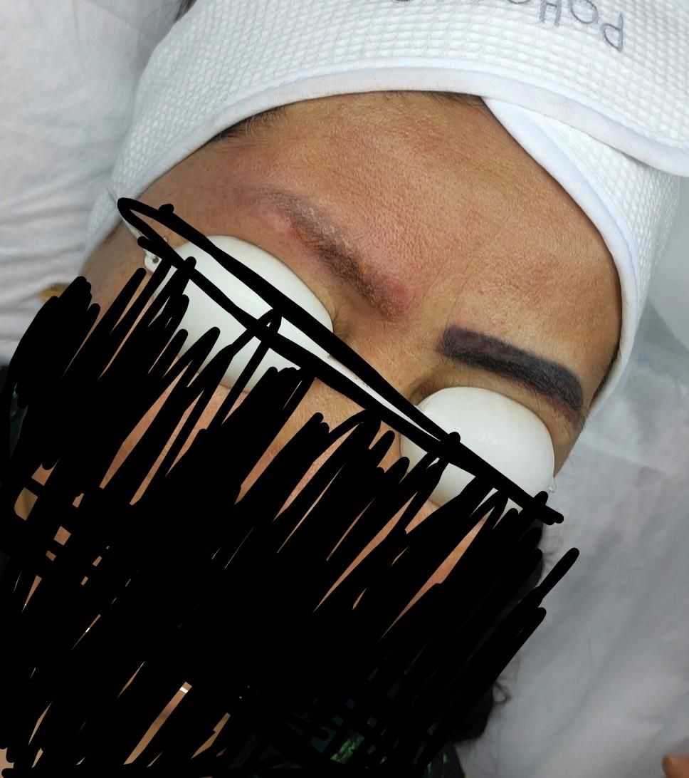 پاک کردن تتو صورت و بدن|خدمات آرایشگری و زیبایی|شاهین‌شهر, مخابرات (شهید بهشتی)|دیوار