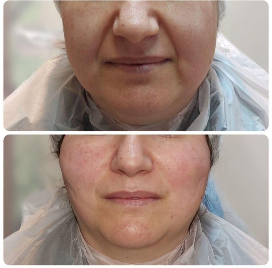 جشنواره تخفیف پی آر پی و ژل و بوتاکس|خدمات آرایشگری و زیبایی|شیراز, زرگری|دیوار