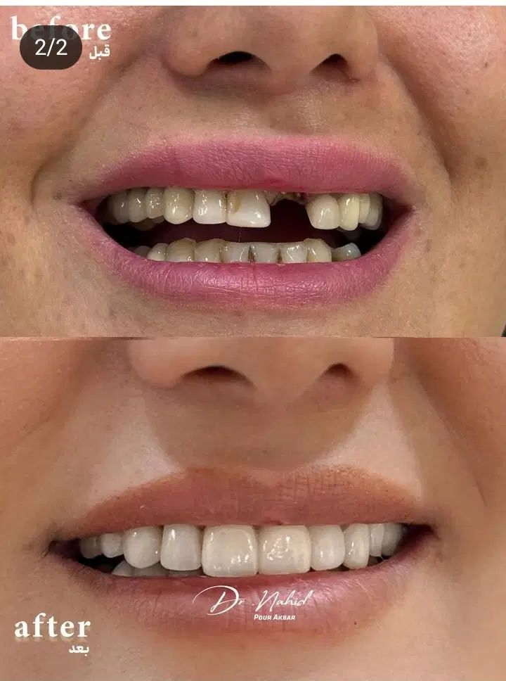 دندانپزشکی/کامپوزیت دیجیتال/ ایمپلنت/عصب کشی|خدمات آرایشگری و زیبایی|مشهد, ده دی|دیوار