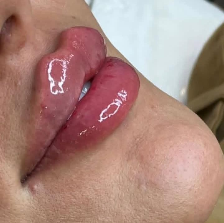 تزریق ژل و بوتاکس لیفت نخ جدیدترین متد مطب زیبایی|خدمات آرایشگری و زیبایی|کرج, گوهردشت|دیوار