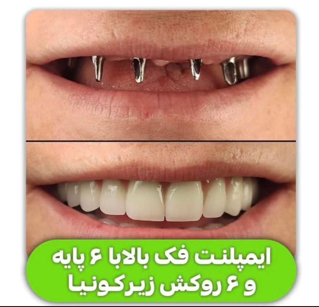 ایمپلنت تخصصی دندانپزشکی توسط ایمپلنتولوژیست فارس|خدمات آرایشگری و زیبایی|شیراز, قصرالدشت|دیوار