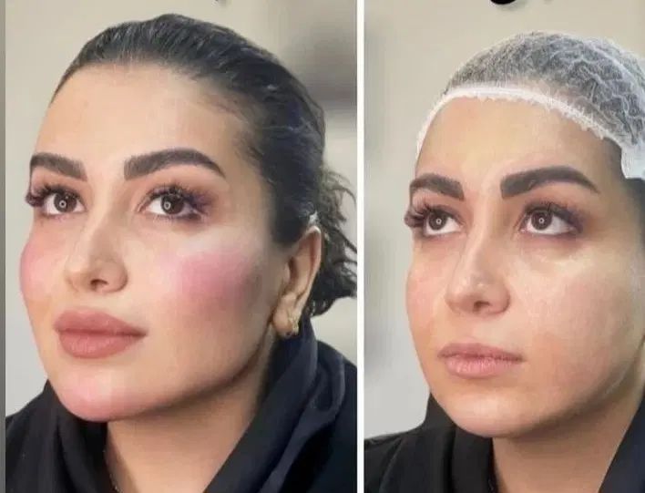 مدل فیلر مدل ژل فول فیس مدل ژل لب مدل گونه و...|خدمات آرایشگری و زیبایی|شیراز, قصرالدشت|دیوار