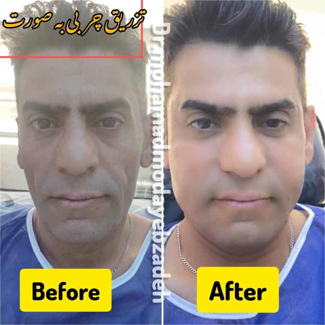 جشنواره ساکشن تخصصی غبغب و تزریق چربی اقساط|خدمات آرایشگری و زیبایی|تهران, شهر زیبا|دیوار
