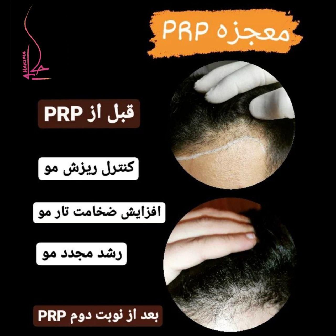پی ار پی PRP ،مزوتراپی،اگزوزوم ولنجک،زعفرانیه|خدمات آرایشگری و زیبایی|تهران, محمودیه|دیوار