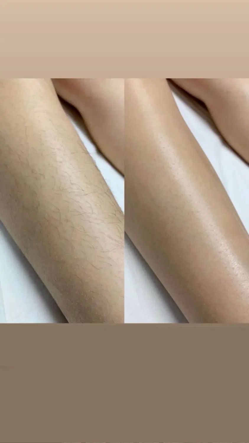 لیزرفول بادی و روشنکننده نواحی تیره ۲۹۰ ژل وبوتاکس|خدمات آرایشگری و زیبایی|قم, حاج زینل|دیوار