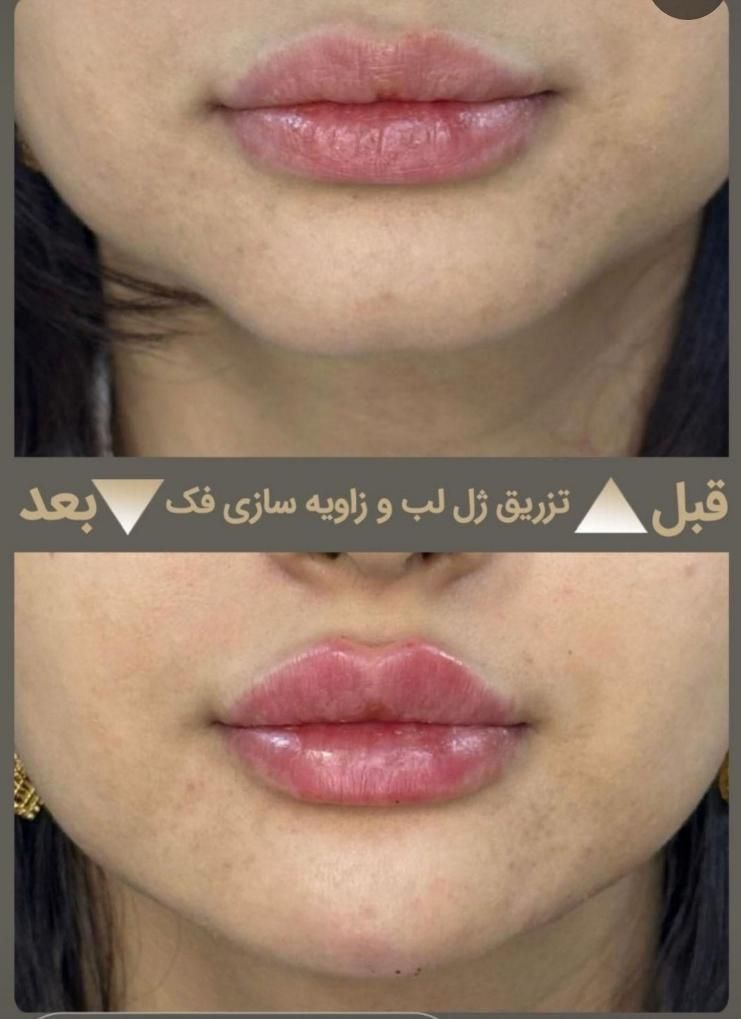 تزریق حرفه ای فیلر در کلینیک زیبایی و لیزر راویس|خدمات آرایشگری و زیبایی|کاشان, رجایی|دیوار