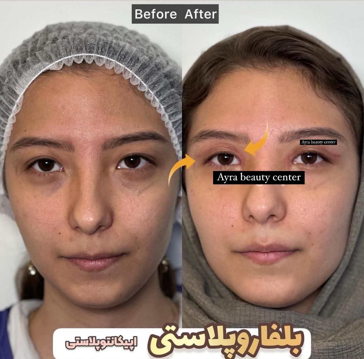 بلفاروپلاستی-سانترال لب-بوکال فت-ساکشن غبغب|خدمات آرایشگری و زیبایی|تهران, پاسداران|دیوار