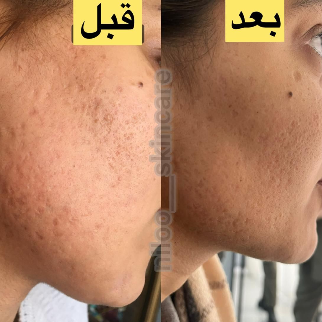 فیشال و پاکسازی،مزونیدلینگ،مزوتراپی،کربوکسی،آنزیم|خدمات آرایشگری و زیبایی|اصفهان, ملک‌شهر|دیوار