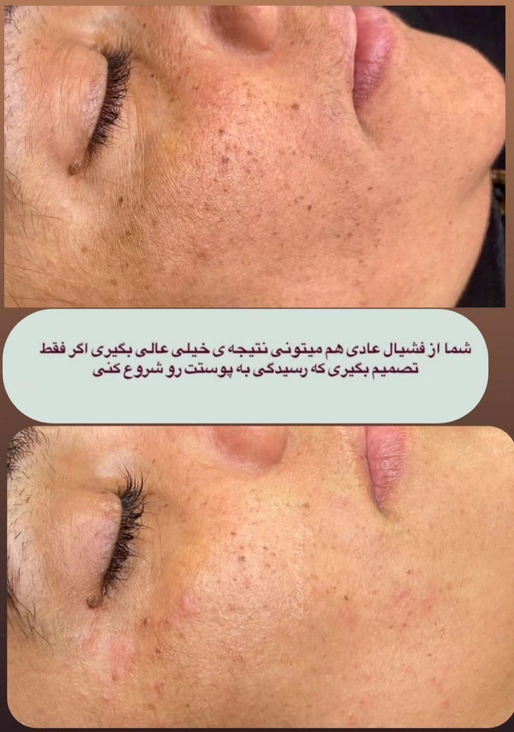 فیشال و پاکسازی پوست|خدمات آرایشگری و زیبایی|اصفهان, فجر|دیوار