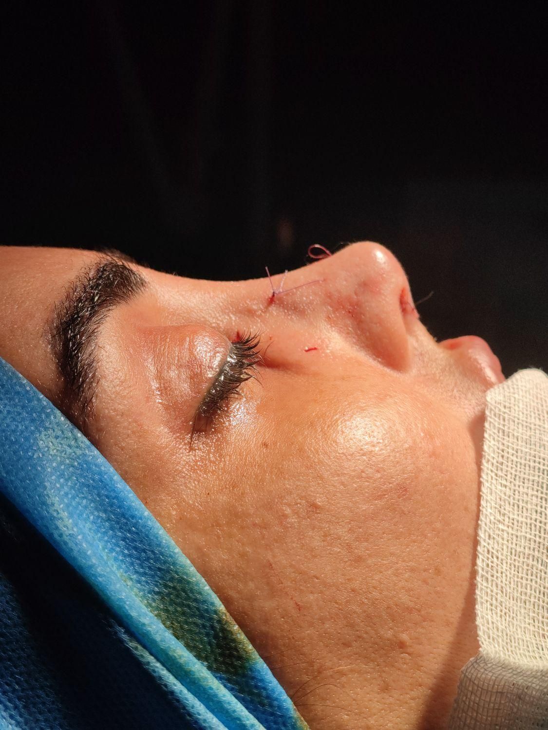 زیبایی بینی۲۹تومن با متخصص گوش و حلق و بینی|خدمات آرایشگری و زیبایی|ورامین, ورامین|دیوار