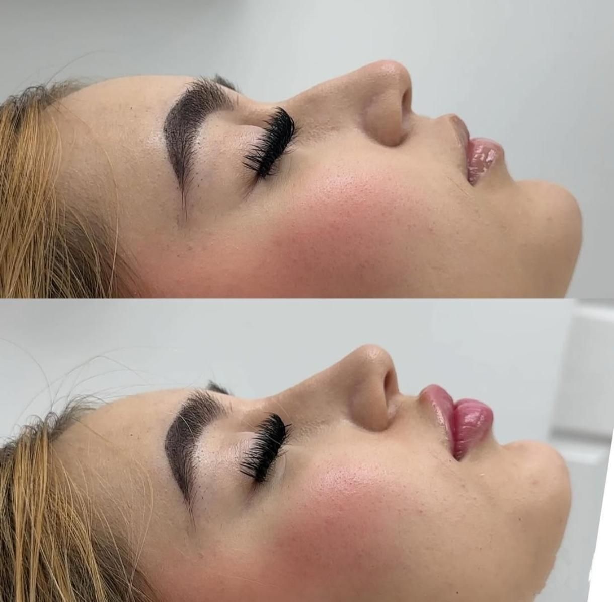 آنزیم ترکیبی بینی، لیفت بینی ژل کانتور صورت لب مزو|خدمات آرایشگری و زیبایی|تهران, سعادت‌آباد|دیوار