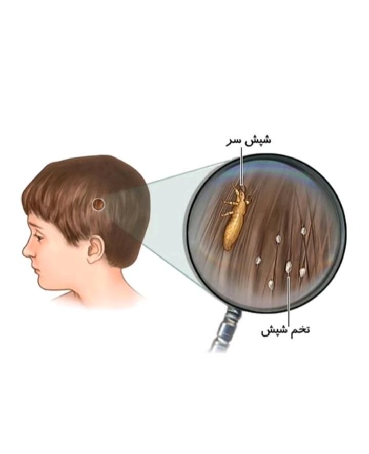 درمان کامل شپش تظمینی|آرایشی، بهداشتی، درمانی|پارس‌آباد, |دیوار