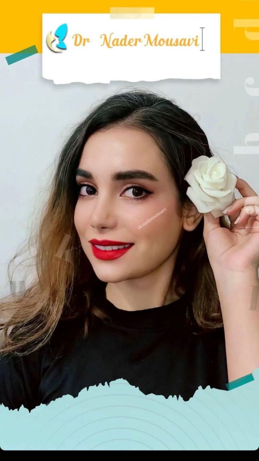 جراحی زیبایی بینی ،گچساران،دکتر نادر موسوی|خدمات آرایشگری و زیبایی|دوگنبدان, |دیوار