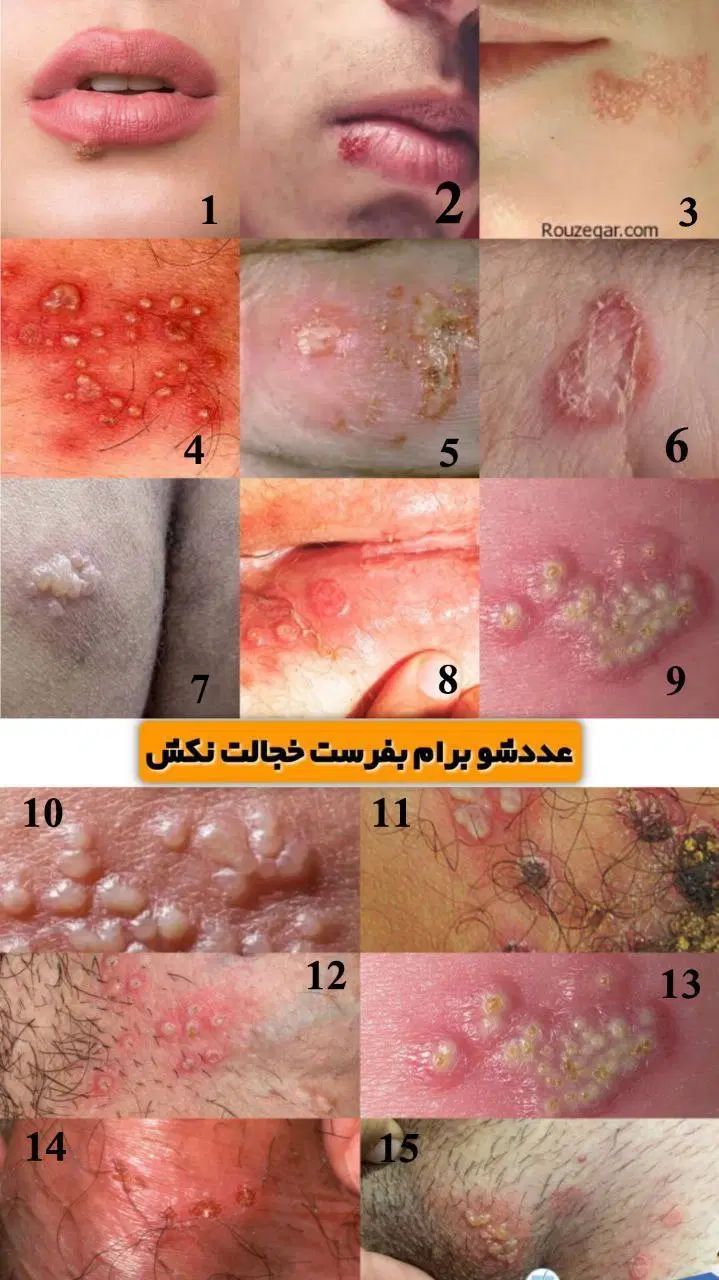 درمان ریشه ای تبخال و زگیل تناسلی با گیاهان دارویی|آرایشی، بهداشتی، درمانی|مشهد, سجاد شهر|دیوار