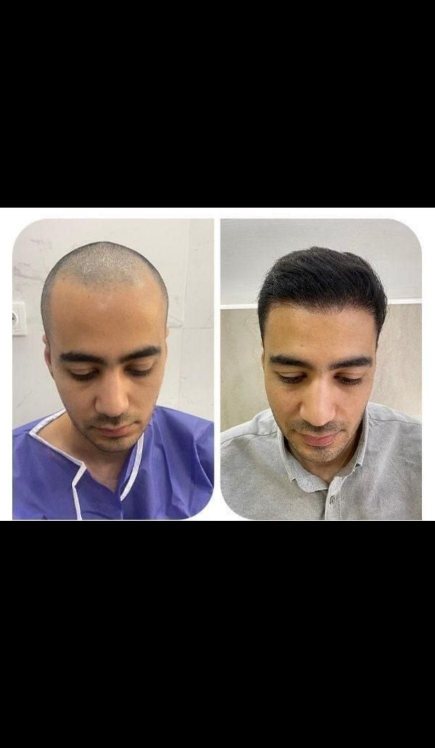 کاشت مو و ابرو در میانه|خدمات آرایشگری و زیبایی|میانه, |دیوار