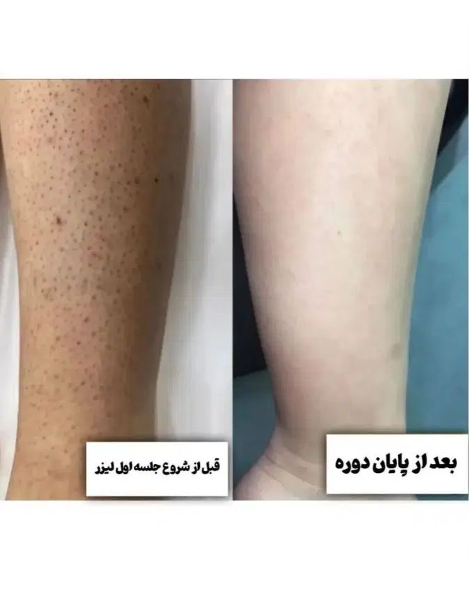 لیزر کاربردی ۲۹۸تومان لیزرفول بادی ۳۹۸تومن|خدمات آرایشگری و زیبایی|اندیشه, اندیشه فاز ۳|دیوار