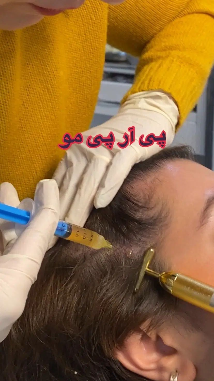پی آر پی مو وصورت|خدمات آرایشگری و زیبایی|رشت, گلسار|دیوار
