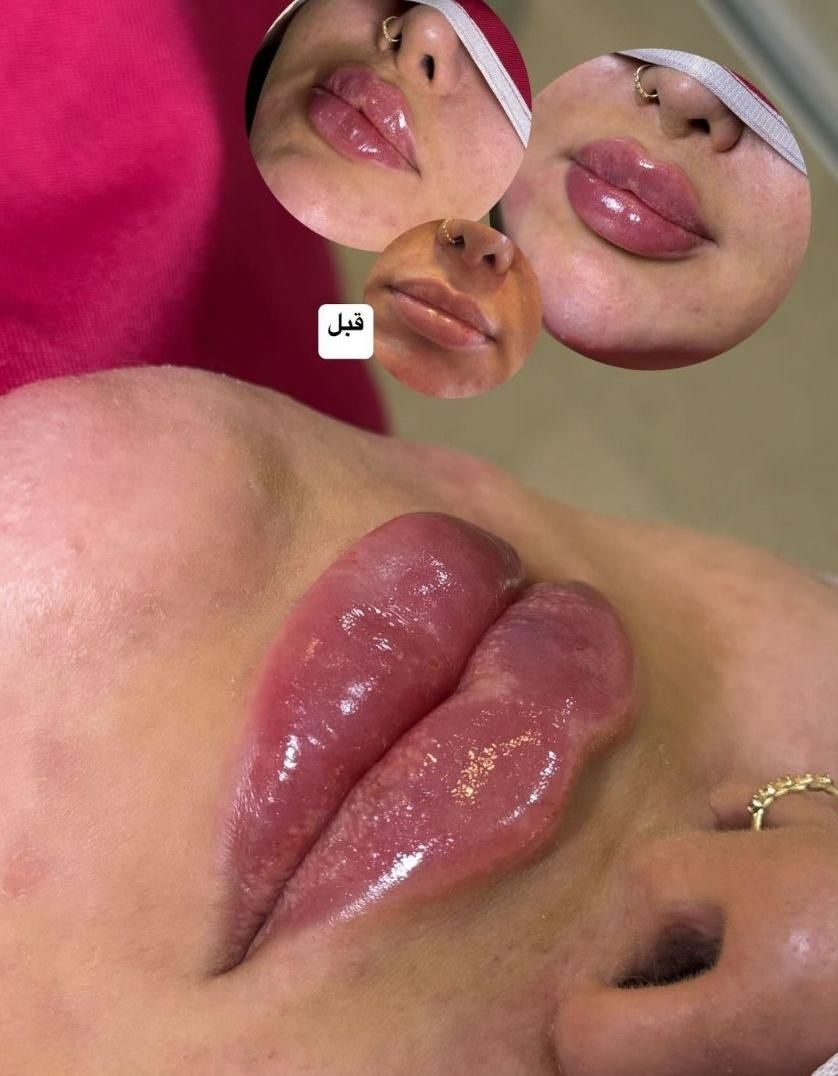 تزریقات ژل .بوتاکس .آنزیم .مزو ژل .مزوسر ضمانتی|خدمات آرایشگری و زیبایی|خرم‌آباد, |دیوار