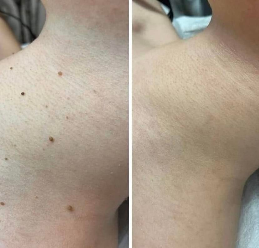 خالبرداری ،رفع کک ومک ،برداشتن میخچه توسط پزشک|خدمات آرایشگری و زیبایی|کرج, شهرک یاس جنوبی|دیوار