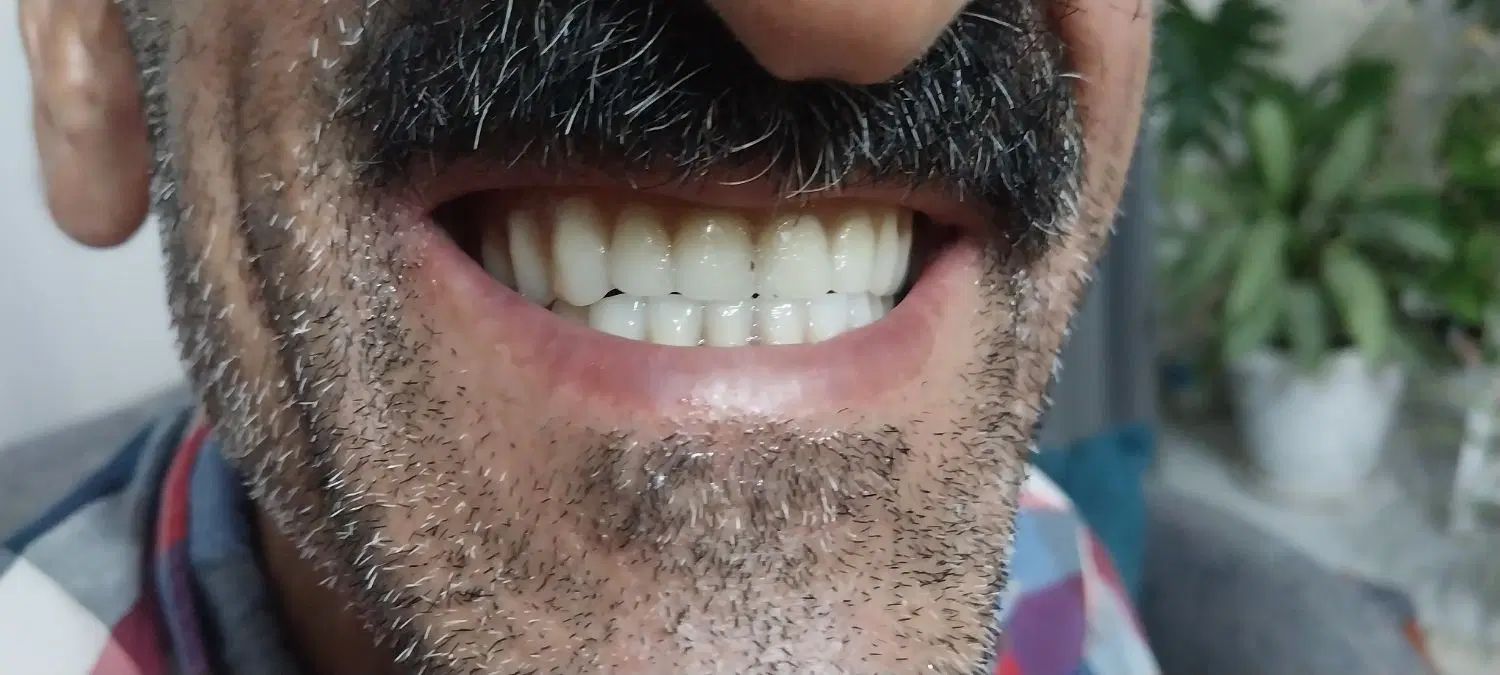 دندان مصنوعی|خدمات آرایشگری و زیبایی|کرج, کوی زنبق|دیوار