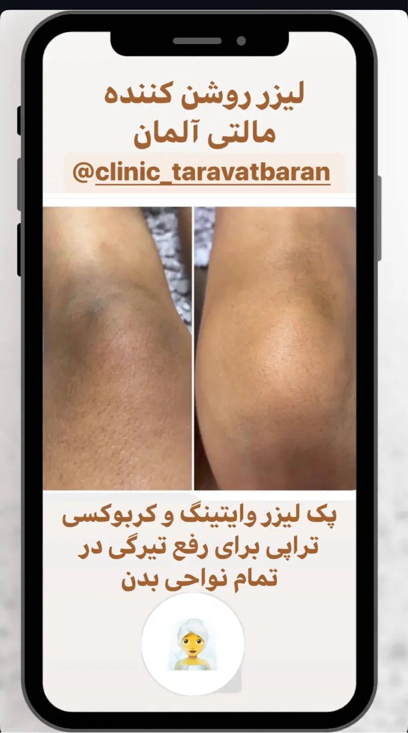 روشن‌کننده هایفو لیزرموزائد پی‌آر‌پی حجم‌سینه‌باسن|خدمات آرایشگری و زیبایی|تهران, صادقیه|دیوار