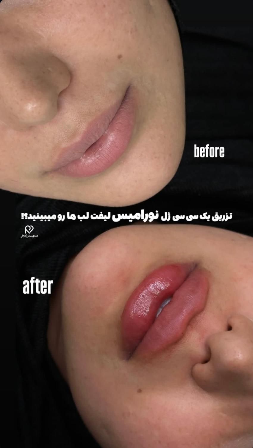 ژل بوتاکس فیلر مطب دکتر لاغری کلینیک پزشک|خدمات آرایشگری و زیبایی|قم, زنبیل‌آباد (شهید صدوقی)|دیوار