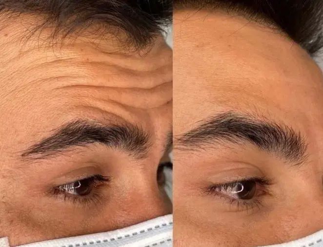 ژل،بوتاکس،مزوتراپی مو صورت،آنزیم،فیلرلب|خدمات آرایشگری و زیبایی|کرج, ساماندهی|دیوار