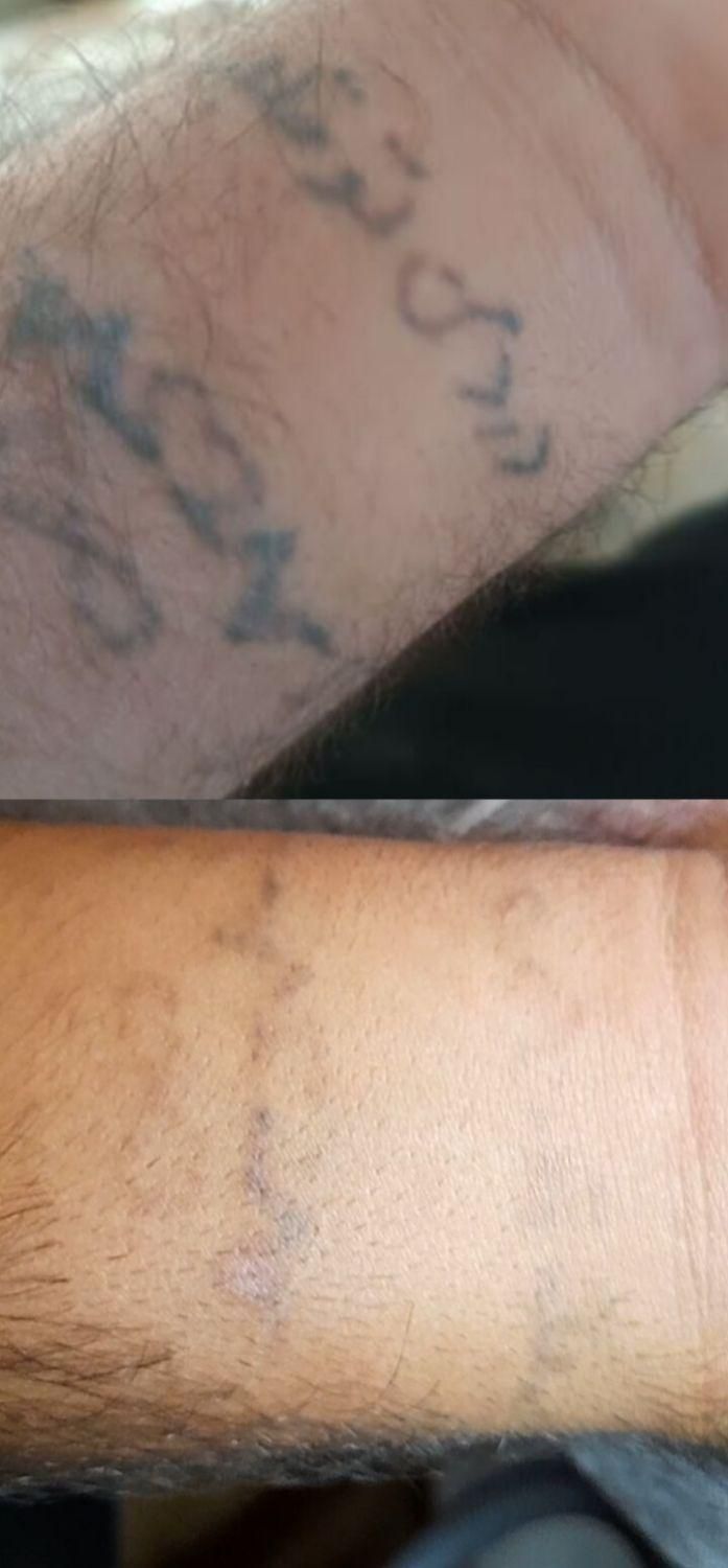 پا ک کردن تاتو ابرو خط چشم لب و بدن دستگاه کیوسویچ|خدمات آرایشگری و زیبایی|کرج, فاز ۱ مهرشهر|دیوار