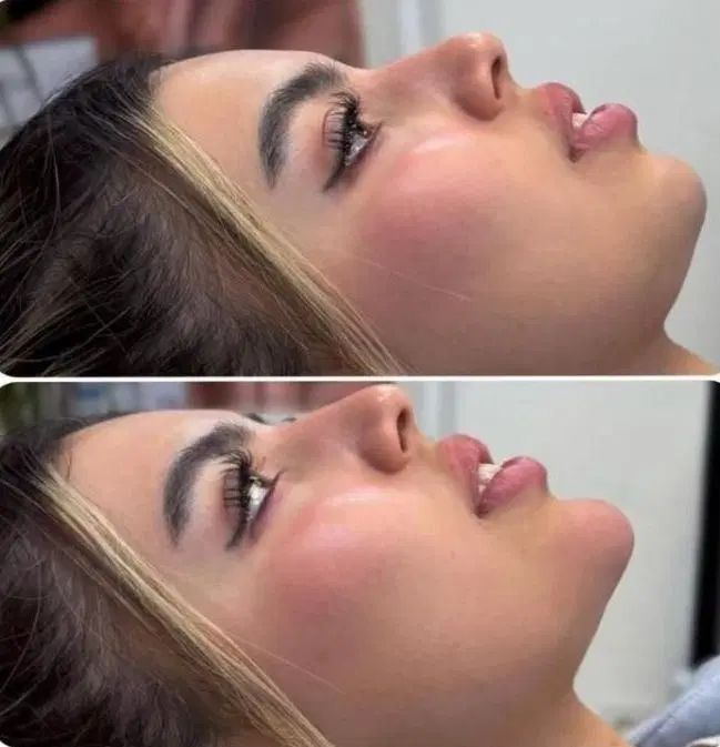 مدل فیلر لب وفول فیس برندهای تک سی سی به مدت ۳روز|خدمات آرایشگری و زیبایی|یاسوج, |دیوار